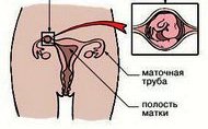 Внематочная беременность